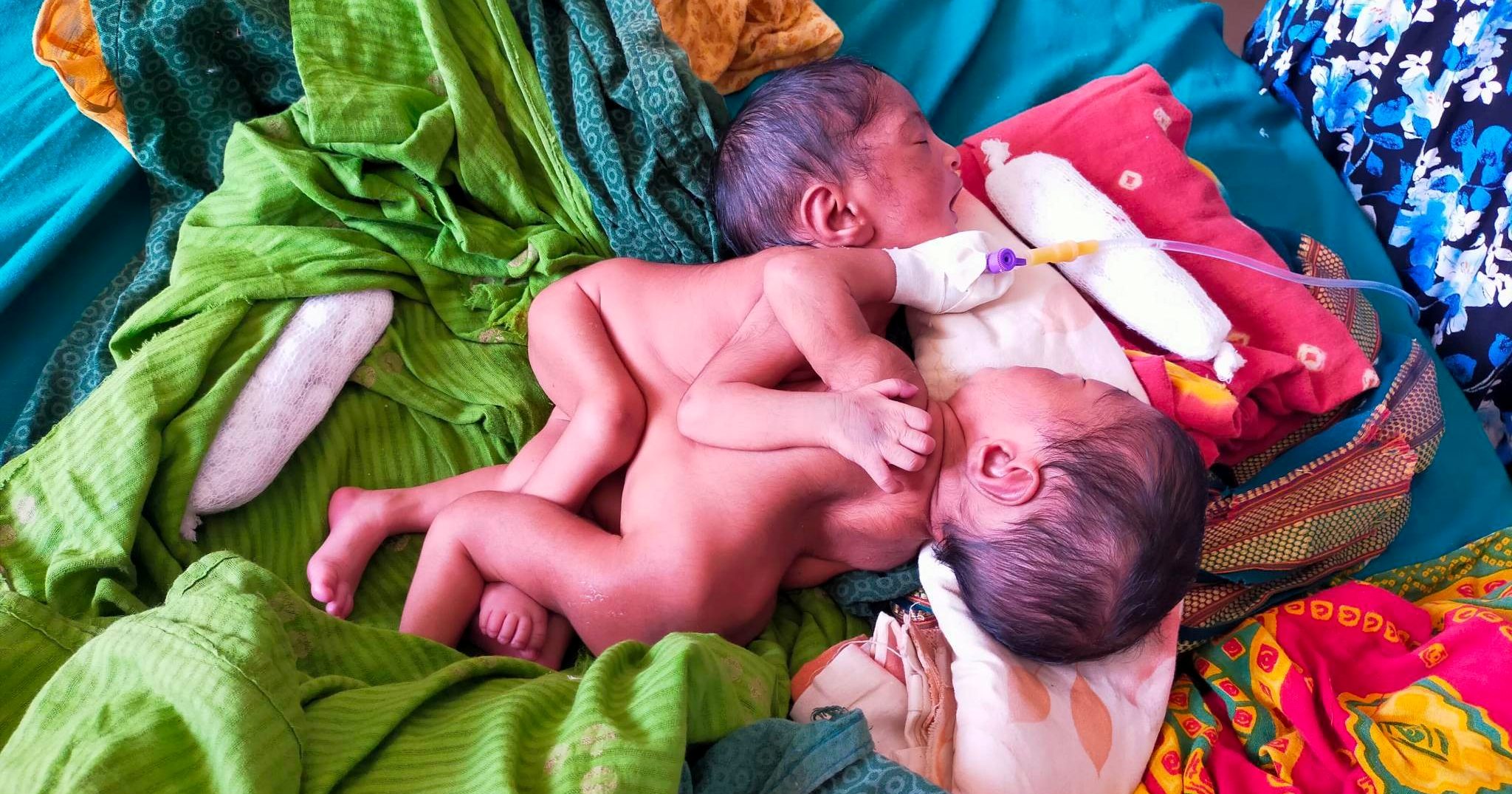 कोशी अस्पतालमा शरीर जोडिएका जुम्ल्याहा बच्चा जन्मिए